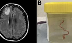 Tıp tarihinde ilk: Avustralya'da bir kadının beyninden canlı halde solucan çıkarıldı