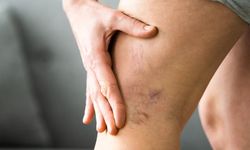 Varis nedir? Varisin belirtileri ve tedavi yöntemleri nelerdir?