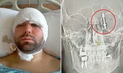 Bursa'da diş doktoru vidayı hastanın beynine sapladı