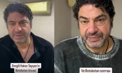 Hakan Taşıyan botoks yaptırdı