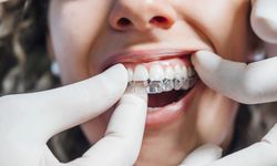 Diş tedavisinde estetik kaygılar nedeniyle 'şeffaf plak' uygulamaları tercih ediliyor