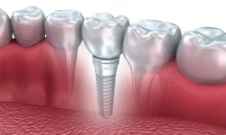 MHP'den Meclis'e 'implant' için kanun teklifi