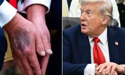 Trump'ın elindeki morluk dikkat çekmişti: Nedeni ortaya çıktı