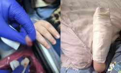 3 yaşındaki çocuğun yürüyen merdivende parmağı koptu