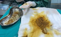 Karın ağrısı şikayetiyle gittiği hastanede safra kesesinden 2 bin 67 taş çıkarıldı