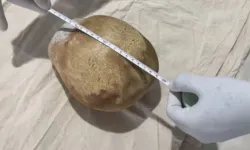 Hastanın vücudundan 3 kiloluk taş çıkarıldı
