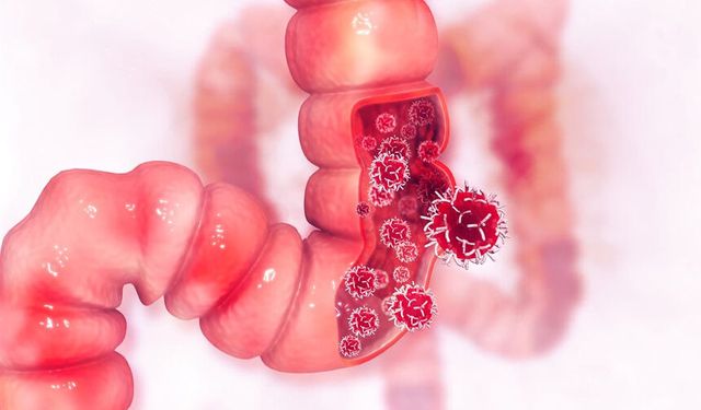 Vakalar 30 yılda ikiye katlandı: Kolon kanseri artık genç hastalığı