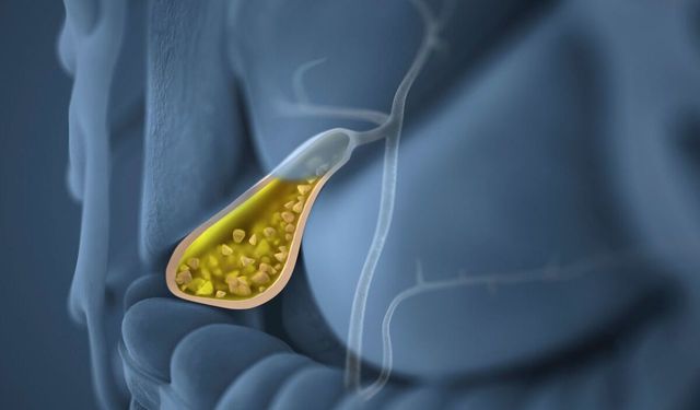 76 yaşındaki kadının safra kesesinden tam 3 bin taş çıktı!
