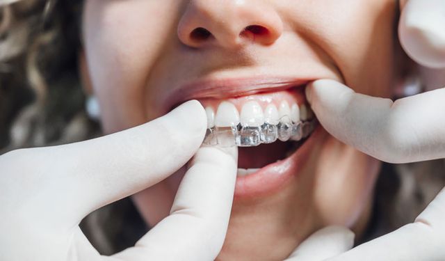 Diş tedavisinde estetik kaygılar nedeniyle 'şeffaf plak' uygulamaları tercih ediliyor