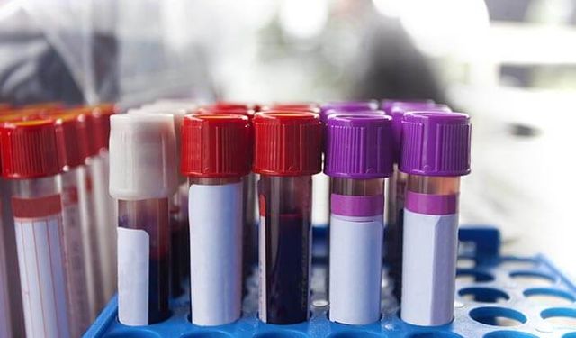 Araştırma: Kan grubu ve erken felç arasında bağlantı tespit edildi