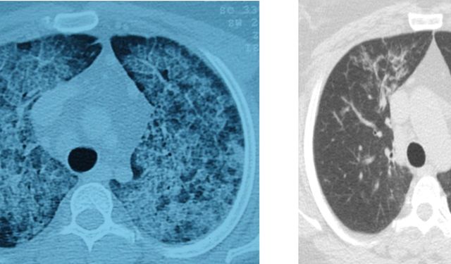 Akciğer yıkaması yöntemiyle hastalar yeniden rahat nefes alıyor