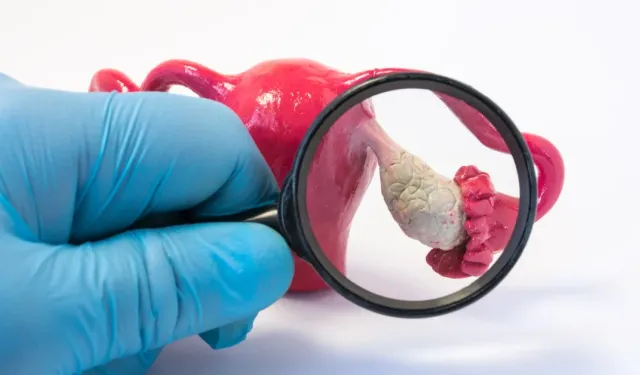 Kadınlarda over kanserinde erken tanı hayat kurtarıyor