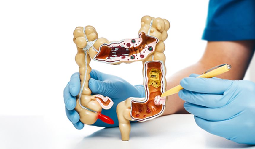 ‘Kalın bağırsak kanserini yüzde 90 oranında önlemek mümkün’