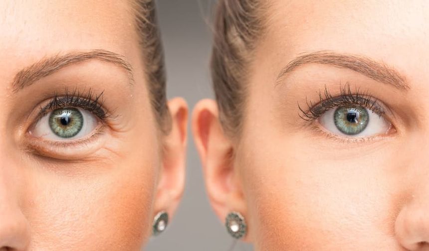 15 yaşa kadar düşen 'botoks' uygulaması ileri dönemde cilt hastalıklarını artırabiliyor