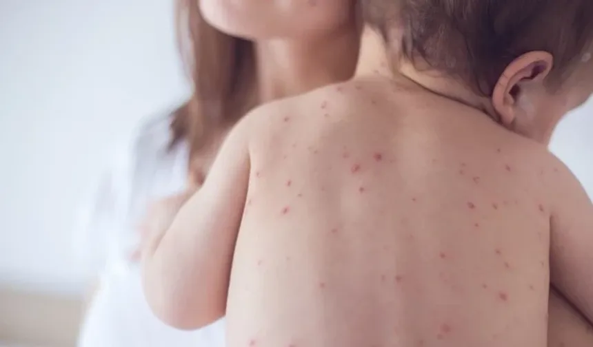 Okullarda suçiçeği alarmı: Bu üç belirtiye dikkat!