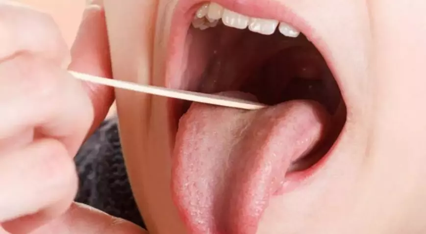 Dil kenarında başlayan hafif sızı kanser çıktı!