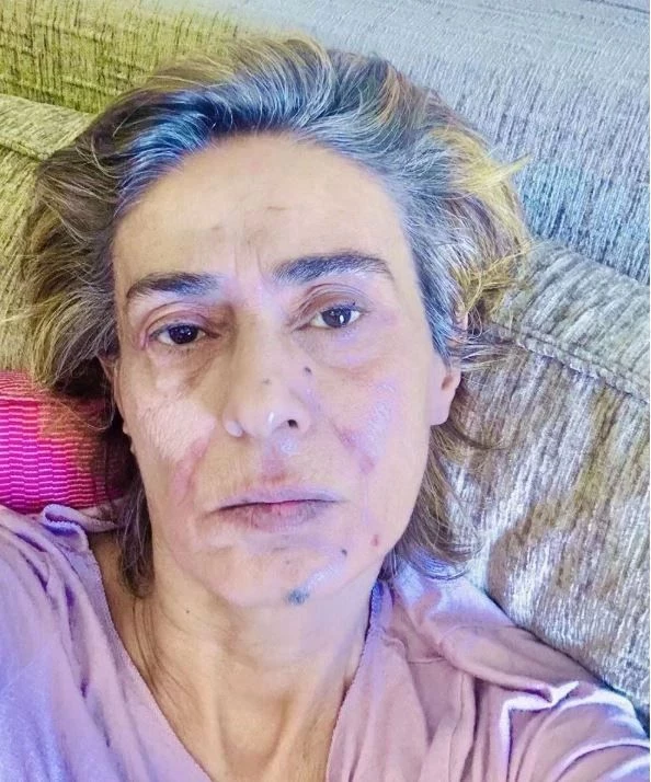 Yıldız Tilbeyi Örümcek Isırdı